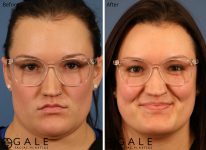 before and after front view facial liposuction of female patient 1233