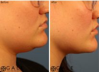 before and after closeup right view facial liposuction of female patient 1233