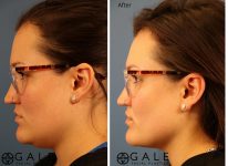 before and after left side view facial liposuction of female patient 1233