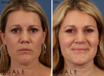 before and after front view rhinoplasty of female patient Riverton, Utah