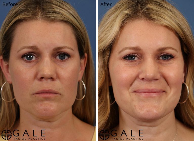 before and after front view rhinoplasty of female patient Riverton, Utah