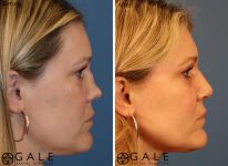 before and after right view rhinoplasty of female patient Riverton, Utah