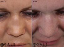 before and after closeup view rhinoplasty of female patient Riverton, Utah