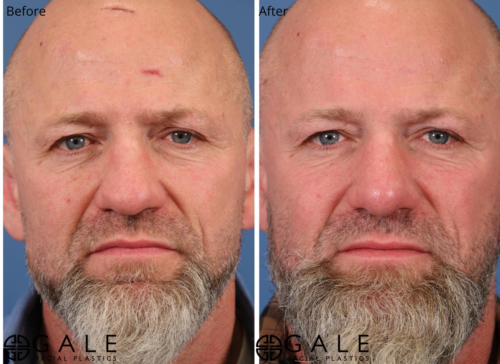 before and after front view rhinoplasty of male patient Riverton, Utah