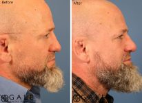 before and after right view rhinoplasty of male patient Riverton, Utah