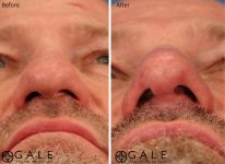 before and after closeup view rhinoplasty of male patient Riverton, Utah