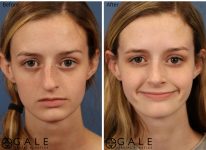 before and after front view rhinoplasty of female patient Riverton, Utah
