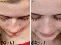 before and after closeup down view rhinoplasty of female patient Riverton, Utah