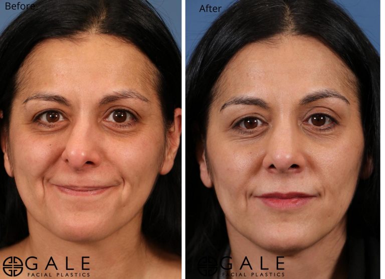 before and after front view rhinoplasty of female patient Riverton, Utah