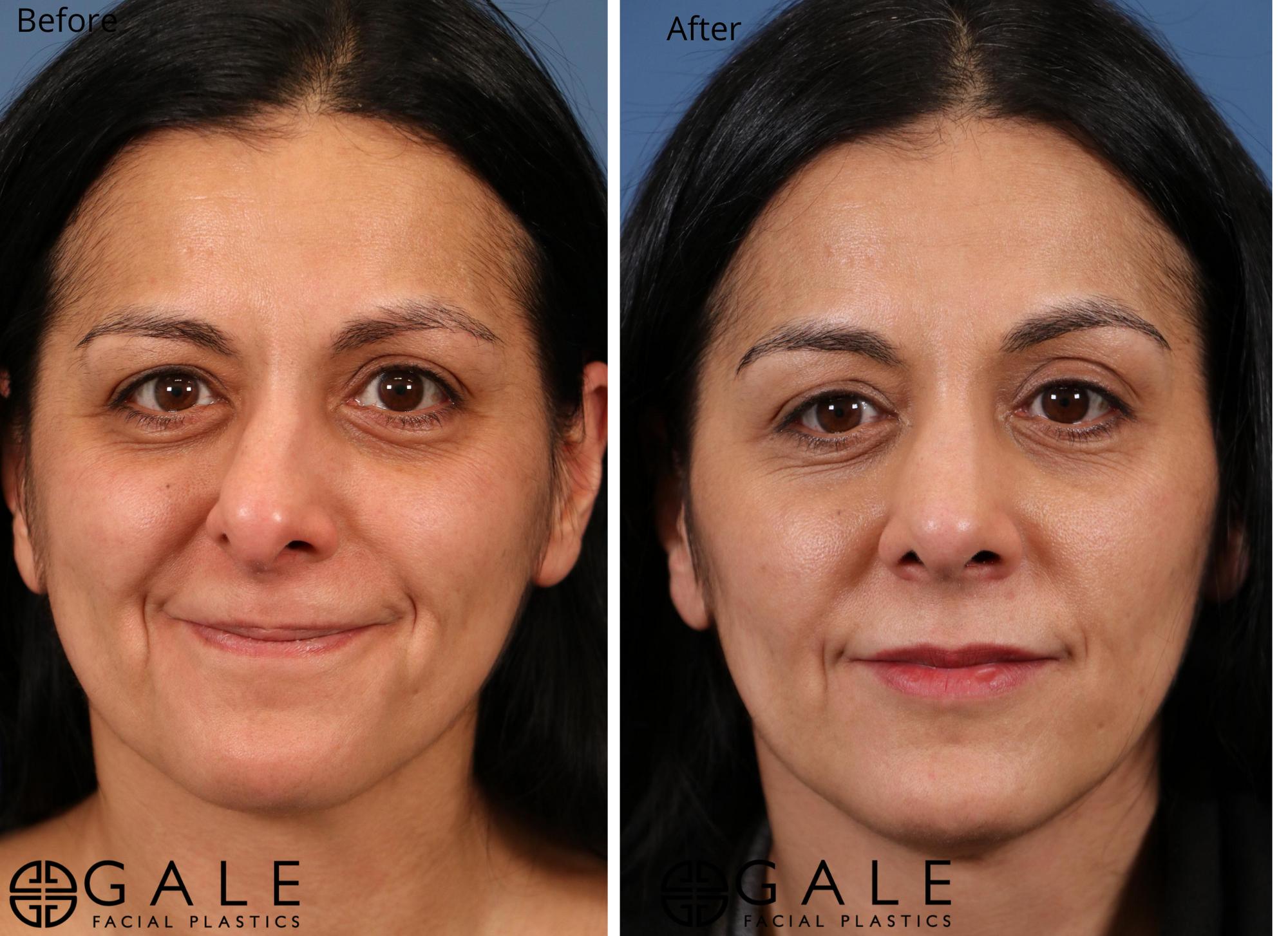 before and after front view rhinoplasty of female patient Riverton, Utah