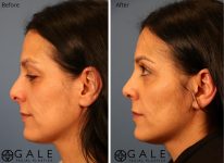 before and after left view rhinoplasty of female patient Riverton, Utah