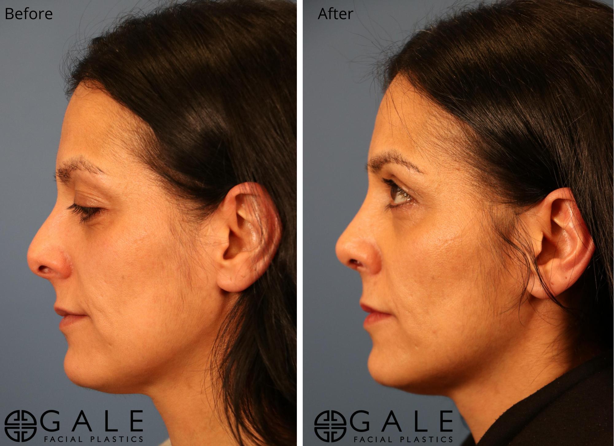 before and after left view rhinoplasty of female patient Riverton, Utah