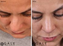 before and after closeup down view rhinoplasty of female patient Riverton, Utah