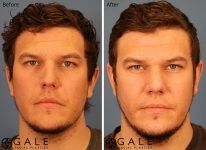 before and after front view rhinoplasty of male patient Riverton, Utah