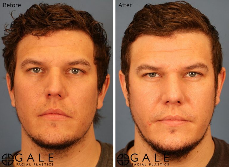 before and after front view rhinoplasty of male patient Riverton, Utah