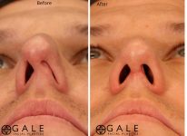 before and after closeup view rhinoplasty of male patient Riverton, Utah